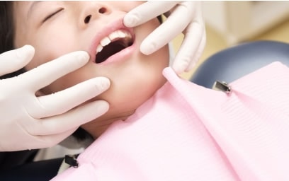 奥歯のむし歯を予防するシーラント