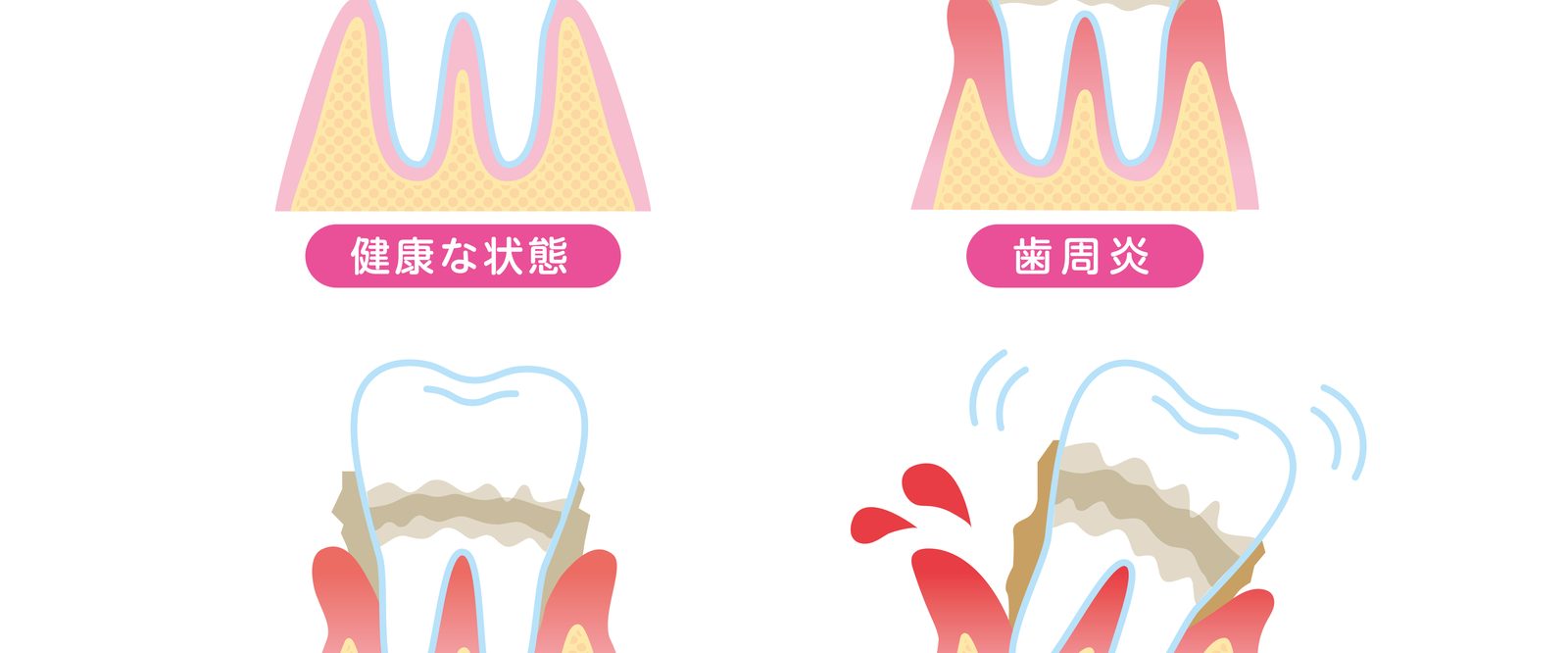 歯周病の進行段階